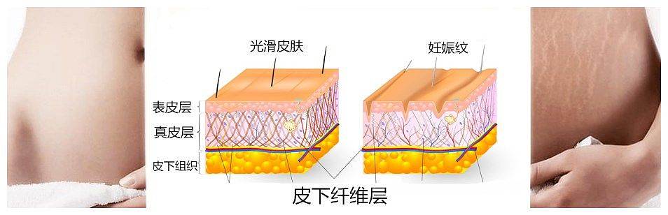 去妊娠纹  妊娠纹是皮肤里层的纤维层断裂,普通的妙招方法不可能修复